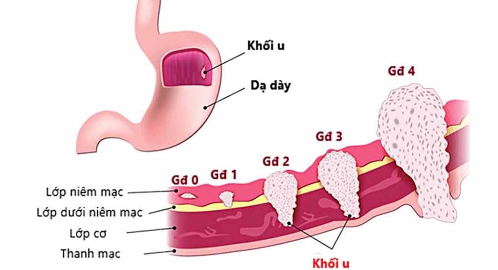 cac-giai-doan-cua-benh-ung-thu-da-day