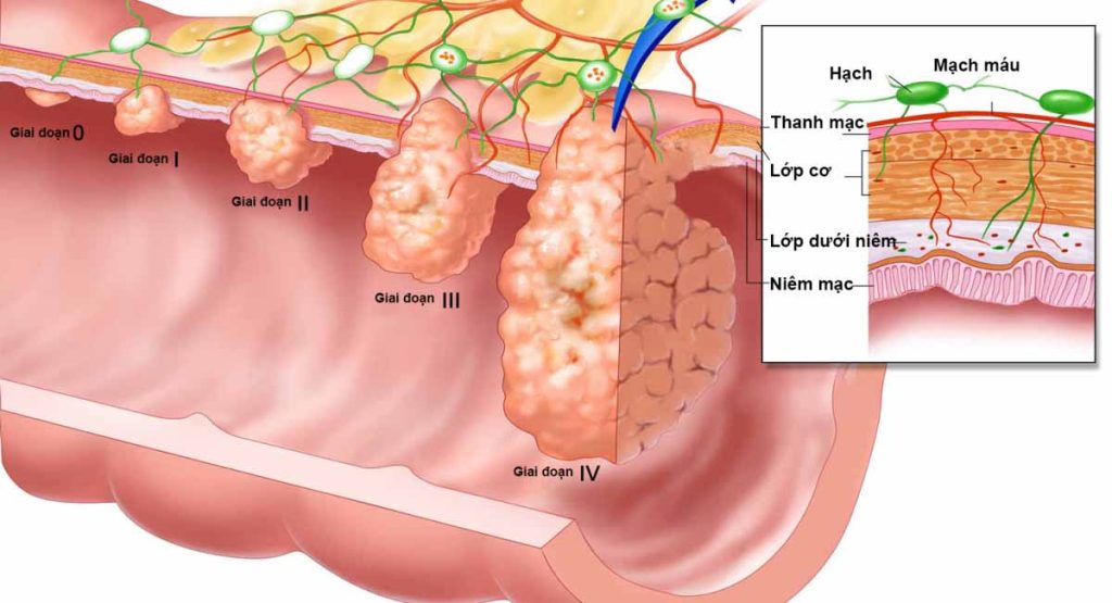 cac-giai-doan-cua-benh-ung-thu-thuc-quan