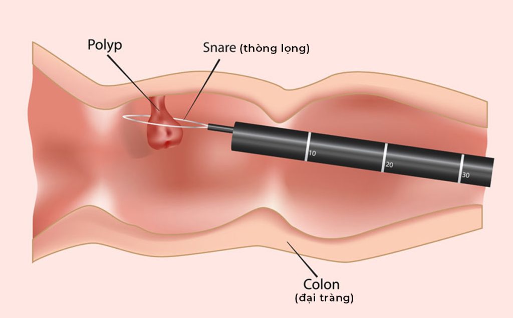 ky-thua-cat-polyp-qua-noi-soi