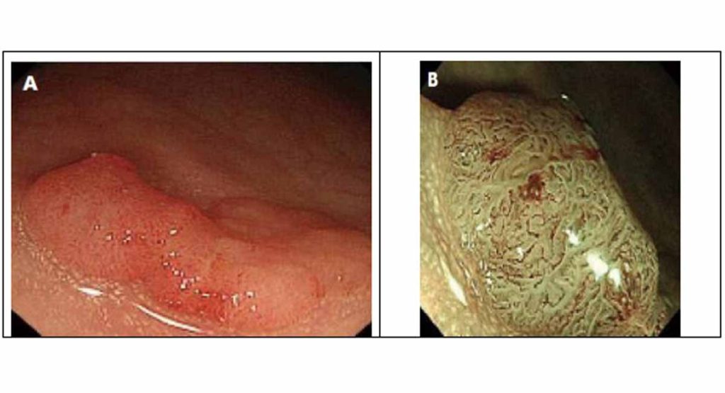 noi-soi-polyp-dai-truc-trang