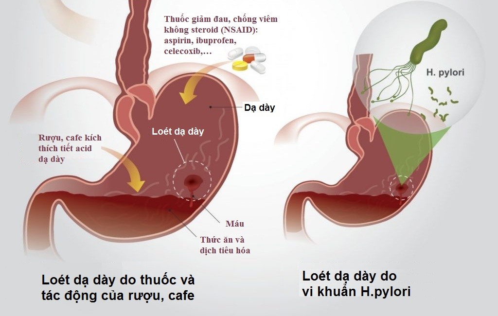 vi-khuan-Helicobacter-pylori-gay-viem-loet-da-day